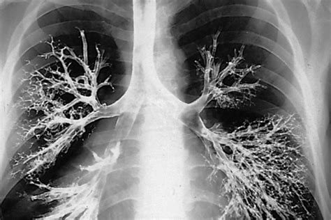 Weird but True | Small tree found growing inside Russian man’s lung dgtl - Anandabazar