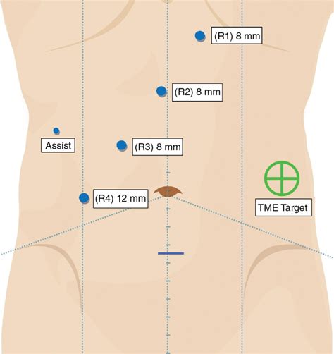 Splenic flexure mobilization | Basicmedical Key