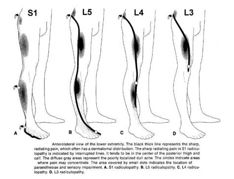 Radiculopathy | Physical therapy, Radiculopathy, Massage therapy