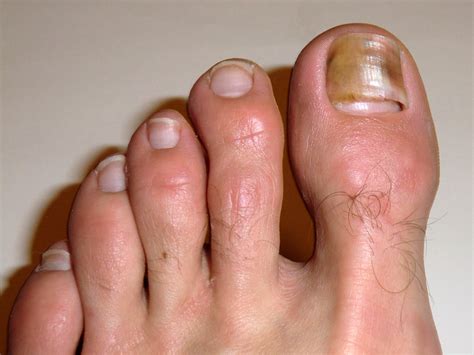 Toenail Damage From Hiking - Nail Ftempo