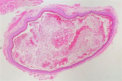 Epidermal Inclusion Cyst