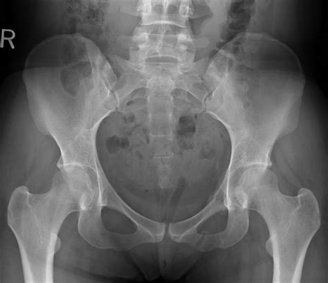 Normal Pelvis X Ray