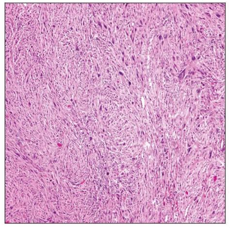 Histiocytoma Histology