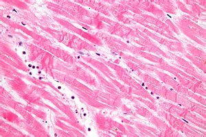 Myocardial infarction - Libre Pathology