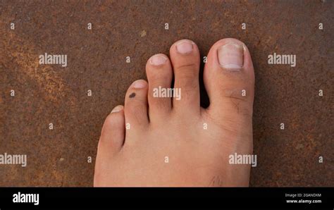 Foot with second toe equal to the big toe which is called Roman toe Stock Photo - Alamy