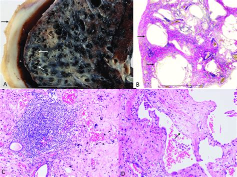 Histology of usual interstitial pneumonia-type asbestosis in a ...