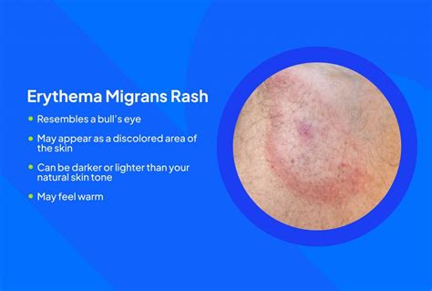 Erythema Migrans Rash: A Guide to Understanding Its Causes, Symptoms ...