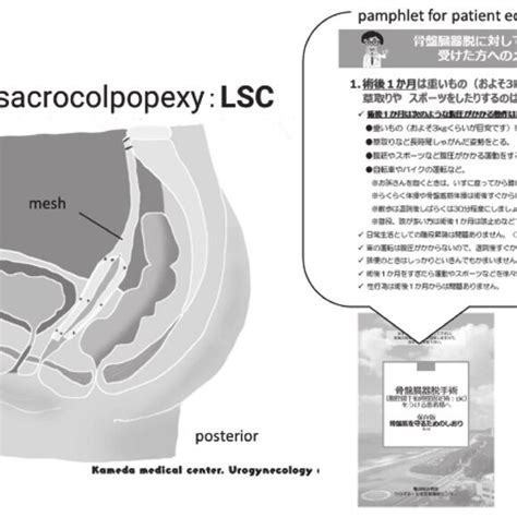 Laparoscopic sacrocolpopexy （LSC） and leaflet for after surgery ...