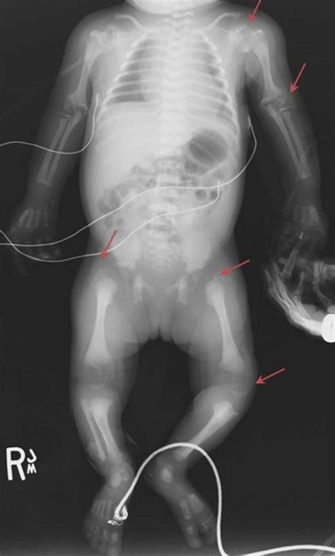 Rhizomelic chondrodysplasia punctata causes, symptoms, diagnosis, treatment & life expectancy