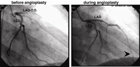 Coronary angiogram showing a total occluded left anteri | Open-i