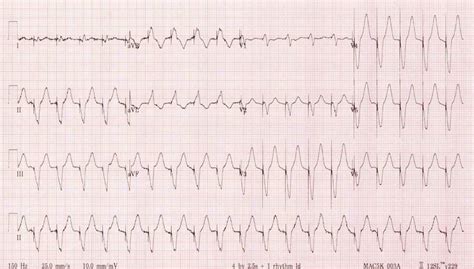 Ventricular Tachycardia Vs Supraventricular Tachycardia