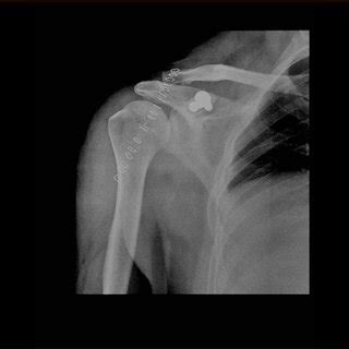 The CT scan image showing the displaced fracture coracoid. | Download Scientific Diagram