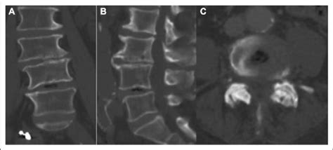 Minimal vacuum phenomenon at L4-L5 lumbar spine, note the central air ...