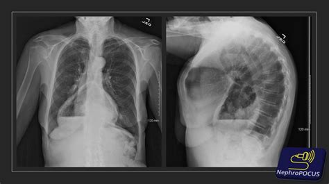 Hiatal hernia on Focused Cardiac Ultrasound – NephroPOCUS