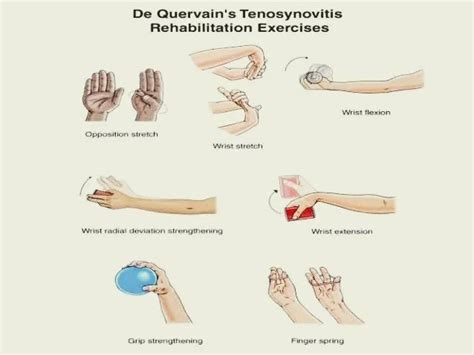 De Quervain Tenosynovitis Exercises Archives - PT Master Guide