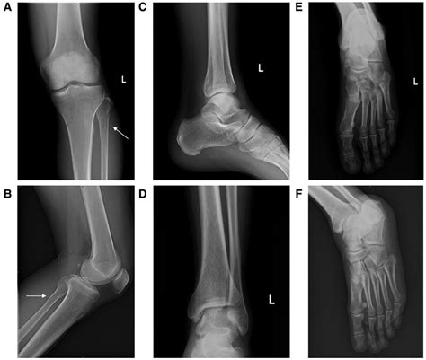 Frontiers | Nonoperative treatment of avulsion fracture of the anterior tibia with proximal ...