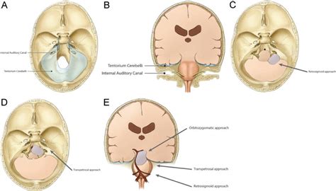 Petroclival meningiomas: an update on surgical approaches, decision making, and treatment ...