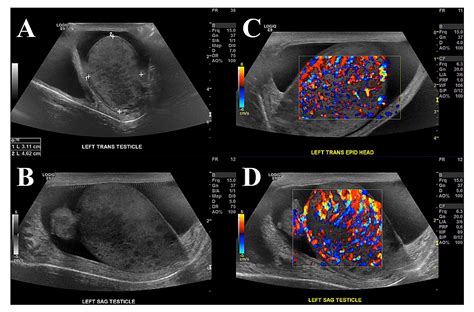 Cureus | Tuberculous Orchitis Following Intravesical Bacille Calmette-Guérin (BCG) Therapy