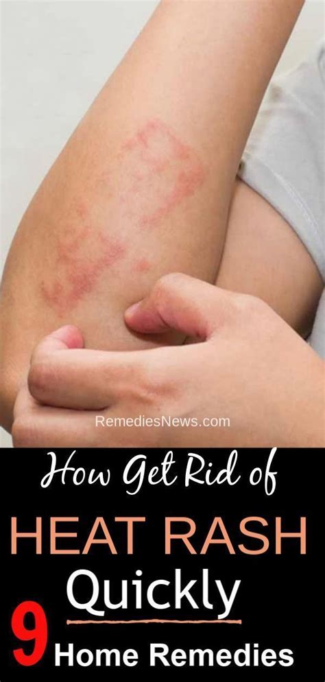 How to Get Rid of Heat Rash Quickly. 9 Natural Remedies for Heat Rash ...