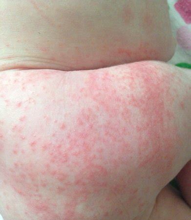 Newborn rash help w/ pic | BabyCenter