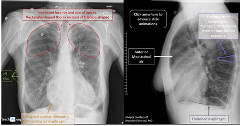 Chronic Obstructive Pulmonary Disease (COPD) - teachIM