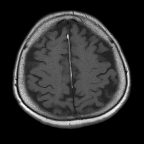 Fatty falx | Image | Radiopaedia.org