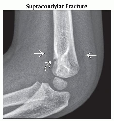 Elbow Effusion | Obgyn Key