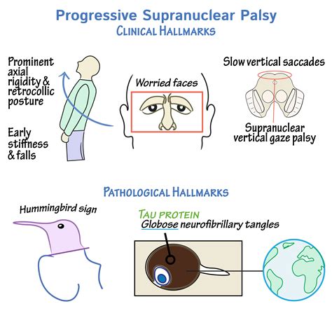 Pathology Glossary: Progressive Supranuclear Palsy | Draw It to Know It