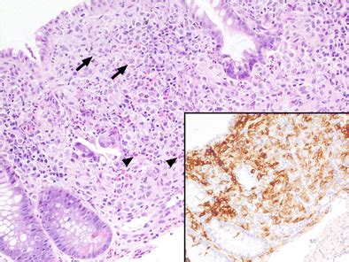 Microphotographs of the colonic biopsy. The sigmoid colon shows focal ...