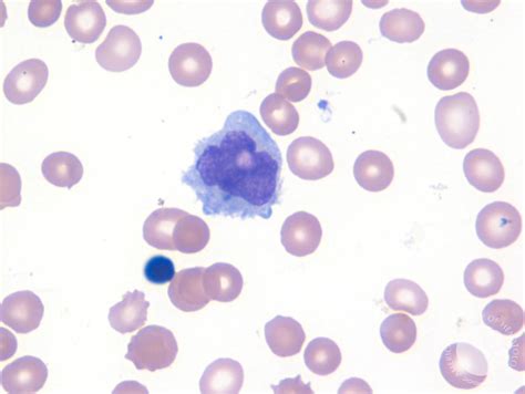 Intravascular DLBCL-Blood