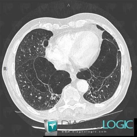 Radiology case : Panlobular emphysema (CT) - Diagnologic