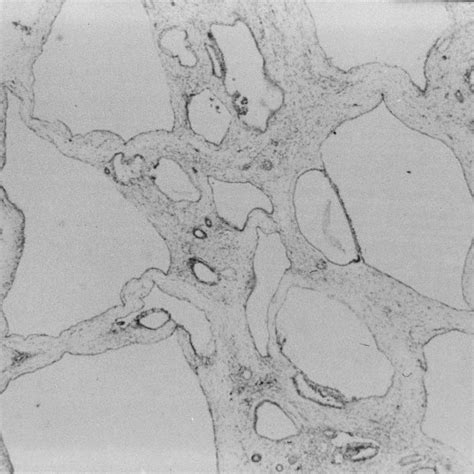 Histology of fetal kidney. Absent nephrogenesis with replacement of ...