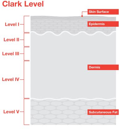 Breslow Depth and Clark Level - Melanoma Research Alliance