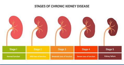 What Are The 5 Stages Of Chronic Kidney Disease?