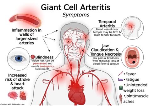 Giant Cell Arteritis - Alberta Rheumatology