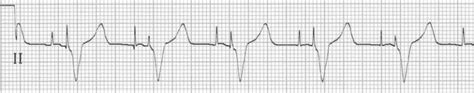 Pacemaker Rhythms – Normal Patterns • LITFL • ECG Library Diagnosis