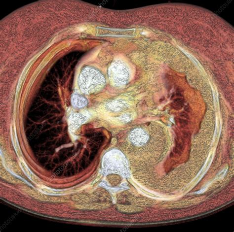 Lung cancer, CT scan - Stock Image - M134/0558 - Science Photo Library