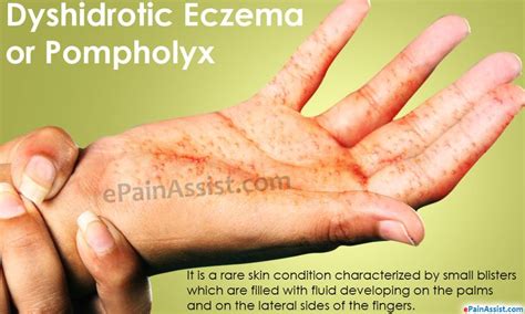 Dyshidrotic Eczema or Pompholyx Read: http://www.epainassist.com/skin/dyshidrotic-eczema-or ...