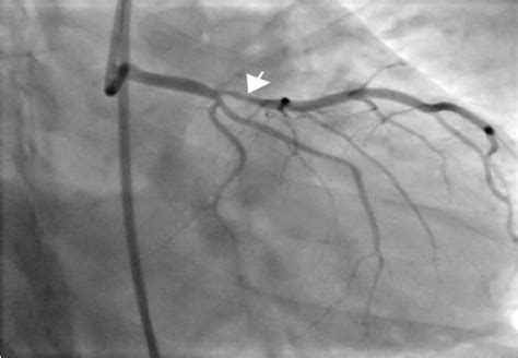 Coronary angiogram with a stenosis of the LAD (arrow) | Download Scientific Diagram