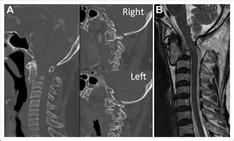 (A) Sagittal CT scan of the cervical spine showing a "Hangman's ...