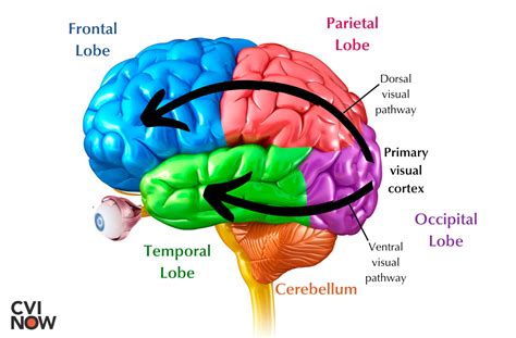 Higher-order visual pathways and the CVI brain – Perkins School for the Blind