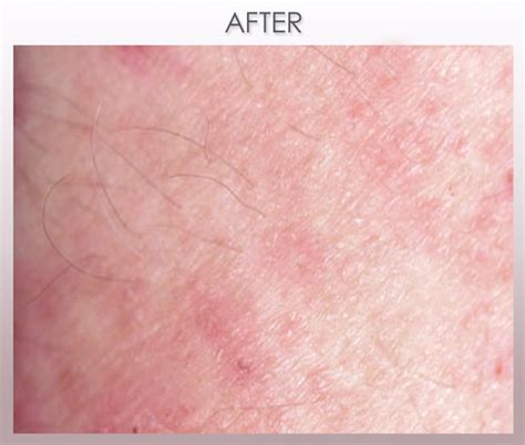 Dr. Scabies Case Studies: Before and After | Best Scabies Treatment: Dr. Scabies - Home ...