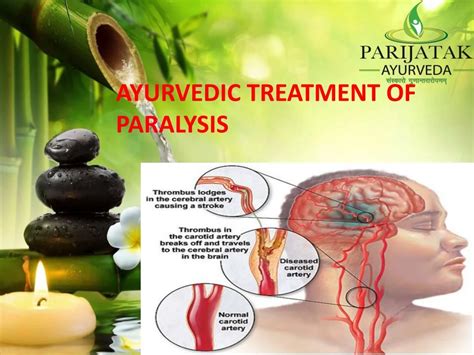 PPT - Best Ayurvedic Treatment Paralysis India |Ayurveda for Paralysis ...