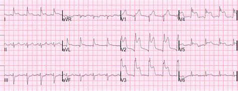 Dr. Smith's ECG Blog: De Winter's T-waves are Not a Stable ECG ...