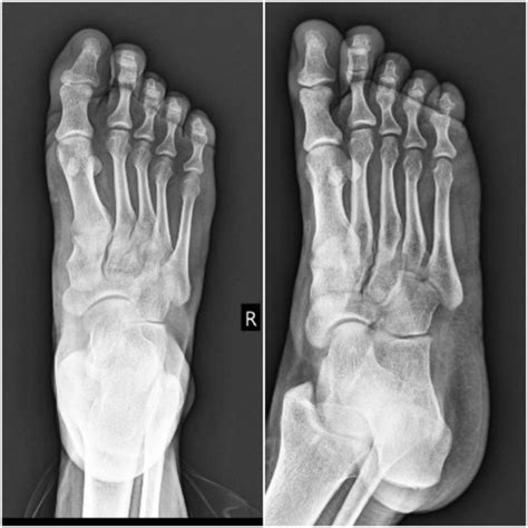 Stress Fracture of Isolated Middle Cuneiform Bone in a Trainee Physician: A Case Report and ...