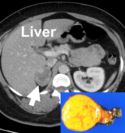 X-Rays, CT Scans, MRI, and Other Tests for Adrenal Glands