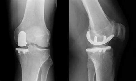 Unicompartmental or Partial Knee Replacement | Proliance Orthopedic