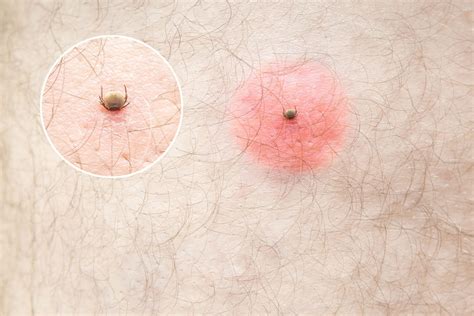 Maladie de Lyme : boutons, traitements, quels symptômes