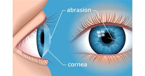 Corneal abrasion: How to treat a scratched eye | Consejos para la salud ...