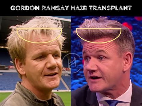 Gordon Ramsay Hair Transplant - Hair Loss & Technical Analysis